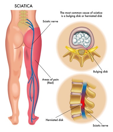 Chiropractic Care for Sciatica